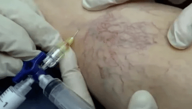 scleroterapie pentru vene varicoase