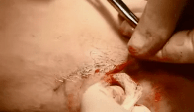 tipuri de operații pentru îndepărtarea venelor varicoase