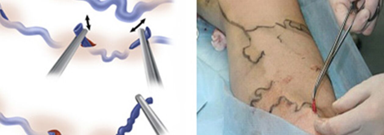 Tratamentul chirurgical al venelor